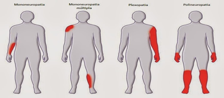 Polineuropatía y Neuropatía