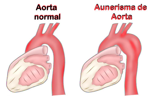 Aunerisma de Aorta