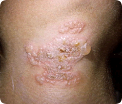 Infecciones por Herpes Genital